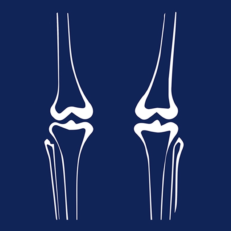 a cartoon line drawing of an xray of the knees