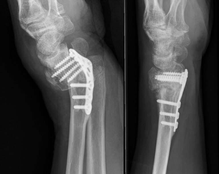 A Bent Wrist Plate - Dr. Anton Lambers – Orthopaedic Surgeon in Bright